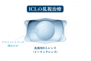 ICLの乱視治療