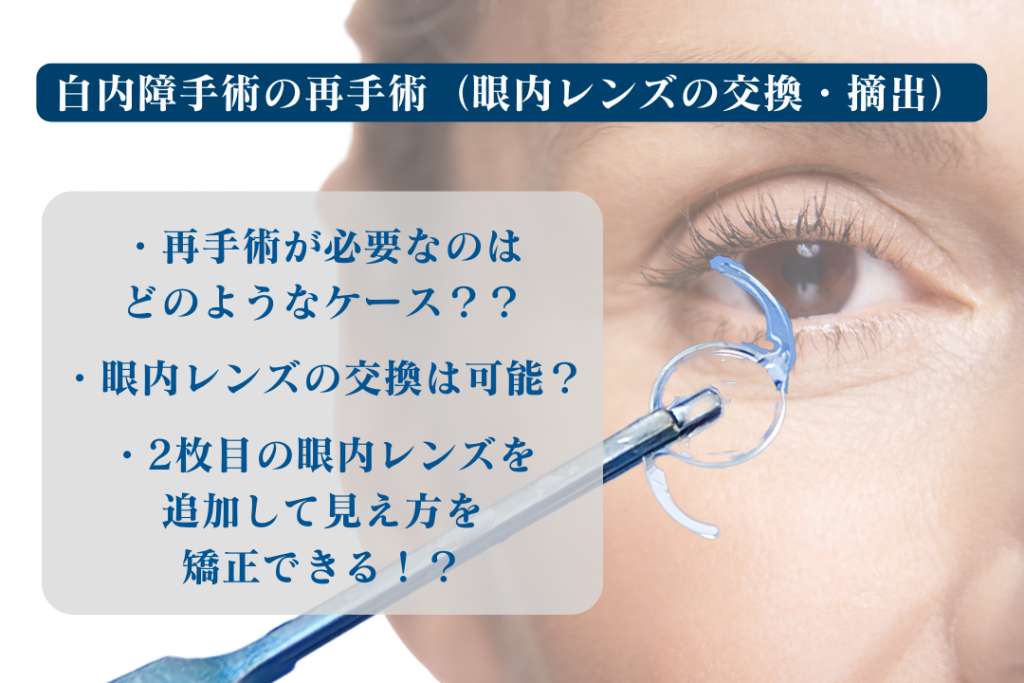 白内障の再手術（眼内レンズの交換・入れ換え手術）について