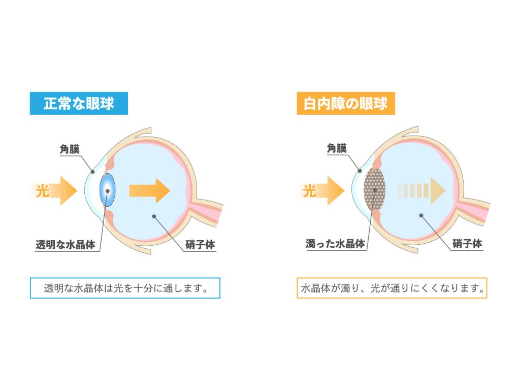 老眼・老視とは-原因・症状・治療について|大阪市港区 よしだ眼科クリニック